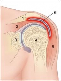injekció fájdalom vállízületek hogyan lehet enyhíteni az ízületi gyulladás kezét